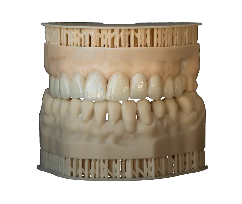 Imagen de Carillas estratificadas