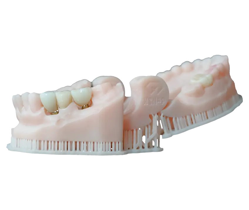 Imagen de Coronas atornilladas