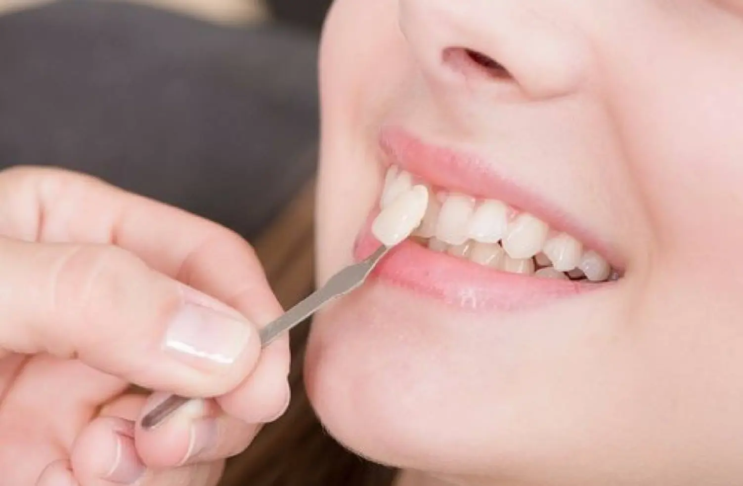 Imagen de HASS porcelain veneers